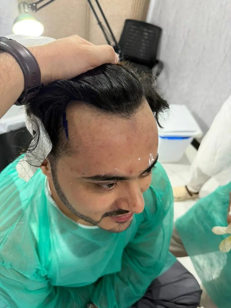 Before FUE hair treatment — patient case case-fue-2800-norwood-v